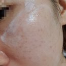 박앤리피부과의원 | 대구 박앤리 피부과 주근깨 제거 후기 - 첫번째