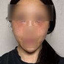 질러 | 급 질러버린 에버클V 후기(눈밑,앞볼,옆볼)