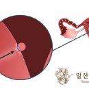 착상혈[implantation bleeding] 이미지