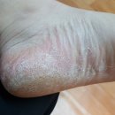 발각질제거 뷰티풋 사용후기!혐오주의ㅋㅋ