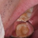 Plus 치과기공소 | 씹을때 어금니 통증, 어금니 깨짐은 레진으로 치료안되고 신경치료 합니다.