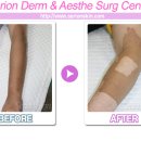 남성반점 이미지