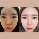 인셀덤순수