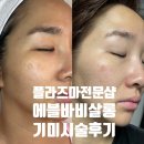 콜드플라즈마 전문 하남 에블바비 기미관리 후기