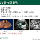 신장 낭종 및 원인과 : 콩팥 물혹 이미지