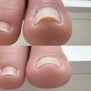 반송동198 | 파고드는 발톱 때문에 아프셨나요?동탄내성발톱교정/동탄북광장네일 옹글네일(전후 비교)