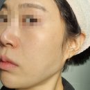 동창공장 | 서현역 한의원 편평사마귀 점 비립종 제거 내돈내산 솔직후기