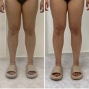 유원메디칼 | 목동 피부관리 :: 쟈민뷰티 | 더조각테라피 하체관리 후기