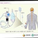 🤕🤕충수(맹장)염 걸려서 복강경으로 수술한 후기🤕🤕(feat. TMI) 이미지