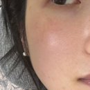 루미에르에스테틱 - 용산구 | 웨딩관리 잘하는 강동구에스테틱 루미에르 에스테틱 무통 재생술 후기!