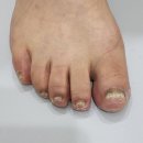 연세밸런스재활의학과의원 | 발톱이 부스러지는 것도 무좀인가요? ㅣ무좀발톱 치료 과정 1회차