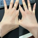 오킴스케이성형외과의원 | [롤리팝성형외과] 오른쪽 팔뚝 문신제거 1회차 후기 (feat. 내돈내산)