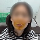 아라치과의원 | [내돈내산] ***서산 아라치과***사랑니 발치 후기