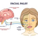 대경한의원 | (여기지축한방병원 황영조 감독 방문후기) 구안와사치료와 대상포진증상의 공통점 -디톡스다이어트 면역...