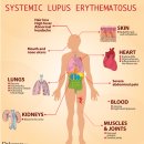 자연적으로 전신성 루푸스를 치료하는 19 가지 방법 ​ 이미지
