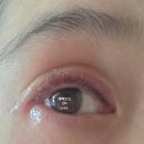 껴봐차봐 | 부산 반영구 아이라인문신제거 1회차 내돈내산 후기 붓기 부작용 회복기간
