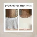 남산동역 8번출구 | 홍대입구역 8번출구피부과 목주름필러 리터치 후기 !