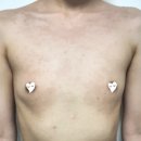 LK메디피아한방병원 | 모티바 285 1, 3개월 가슴보형물 성형 수술 후기