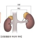 부신기능전하증 이미지