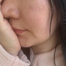 10 | 남양주 다산동피부과 피코토닝 후기