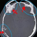 pet 223무7243 | Case_Study_143: 다발성 전이에 의한 두개골암(Skull cancer caused by multiple cranial metastases)