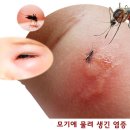 벌레에 물려 죽어가는 사람 이미지