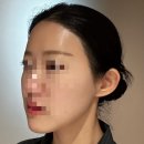 곡선연세가정의원 | [선릉]누브의원_이마필러 후기_통증 붓기 멍(당일~3주차)