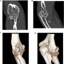 Re: elbow arthritis - humeroradial, humeroulnar, proximal radioulnar joint! 이미지