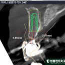 범플란트치과의원 네이버블로그