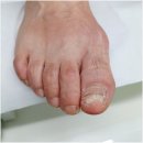 구로 발톱무좀 고민? 서울늘봄메디칼의원 레이저 치료로 샌들 자신감 뿜뿜!