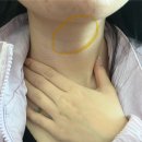 (주)영레이저 | 라피타 오크레이저 내돈내산 후기 | 광고 x | 라피타 오크레이저 브라질리언 효과