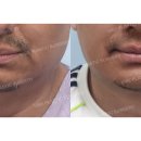 글로벌서울성형외과의원 | 이중턱·턱라인 교정 후기｜캐나다에서 한국까지 찾아온 이유 by 바이브 성형외과 유영문 원장