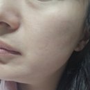 맑은온누리약국 | [뷰티]프락셀 후 관리 필수템! 약국화장품 지피덤EGF재생크림으로 피부장벽 강화하고 수분광 채우기✨