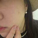 백피부과의원 | 대구 수성구 피부과, 시지 설레임피부과 여드름 후기