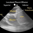 Ultrasound Guidance for Thoracentesis - SonoSite, Inc. 이미지