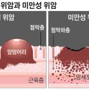 발견하면 3~4기, 젊은층 공격하는 위암 있다 이미지