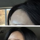 본피부과의원 | 광주 첨단 피부과의원 필러 후기(내돈내산, 전후 사진)