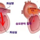 승모판막 협착증[mitral stenosis] 이미지