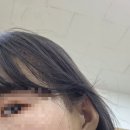 모엠의원 | 머리머리 모발이식 5일차 비절개 2800 후기 (출근/통증)