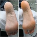 대동아파트후문 | 창원내성발톱 상남동 하이푸스발각질 관리 후기