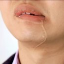 갑자기 눈이 안 감긴다면? 구안와사 회복기간 얼마나 걸릴까 _ 전조증상