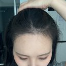 m헤어 | 내돈내산 추천 m자 헤어라인 모발이식 후기 3개월 4개월 비용