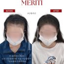 메리티&필모즈스칼프 | 헤어라인 고민? 해운대두피문신 솔직 후기와 꿀팁 모음