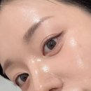 강남피부과의원 | 강남피부과 필로드 시술 후기! |쁨의원 강남 본점