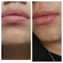 대구한의원 | 동대구한의원 스킨부스터효과 라보센 후기