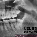 서울프리벤치과의원 네이버블로그