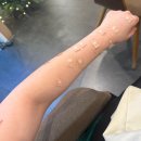 라르떼의원 | 내돈내산 팔 점 제거 후기, 라르떼의원 수유점 (저렴한 비용 개 당 1,100원)