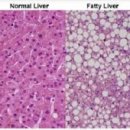 지방간 원인 예방 이미지