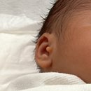 동국대학교일산불교병원 | [건강일기] / 50일 신생아 스킨택 타이 시술 후기 (동국대학교 일산병원 - 어수락 교수)