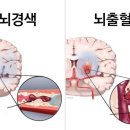 뇌졸중이란 이미지